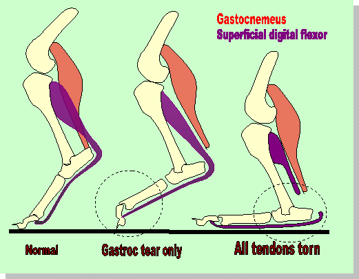 varicoza du-te la sala de gimnastica